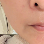 フェイシャル施術後